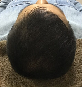 30代男性:3ヶ月経過