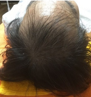 50代男性:3ヶ月経過