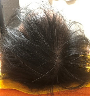 50代男性:6ヶ月経過