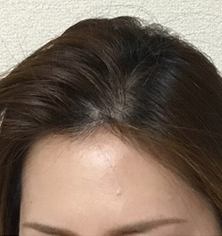 20代女性:6ヶ月経過