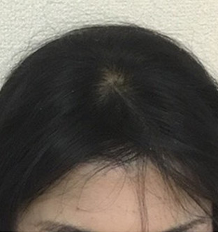 40代女性:6ヶ月経過