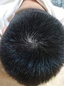 20代男性:3ヶ月経過