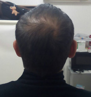 30代男性:6ヶ月経過