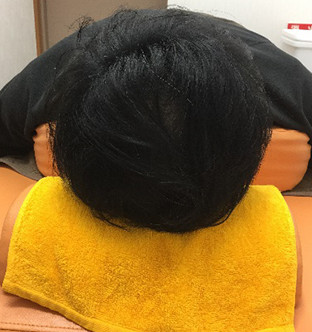 30代男性:12ヶ月経過