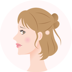 細菌(円形・多発)脱毛症